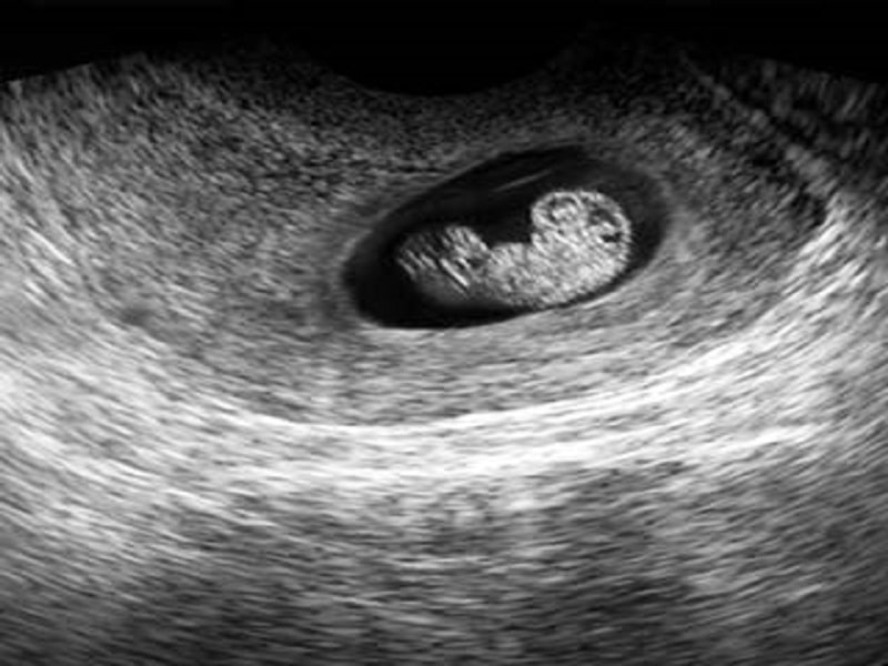 سونوگرافی در هفته هفتم بارداریی